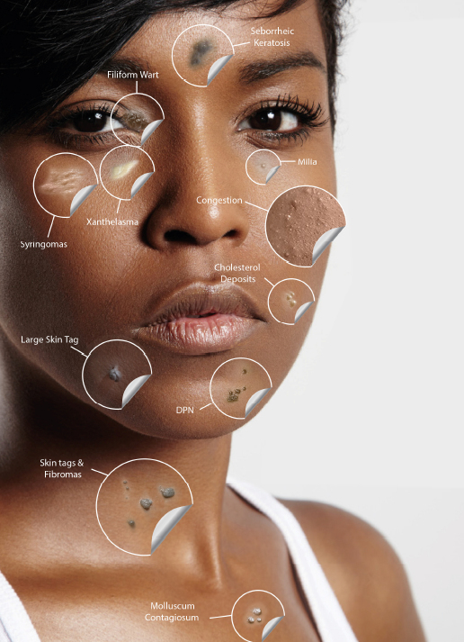 Blemish Removal - The Skin & Body Clinic